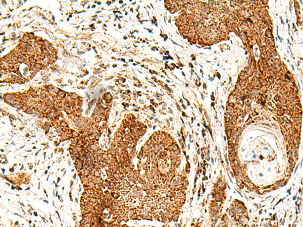 Immunohistochemistry of paraffin-embedded Human esophagus cancer tissue  using SMOC1 Polyclonal Antibody at dilution of 1:50(?200)