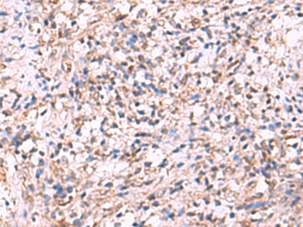 Immunohistochemistry of paraffin-embedded Human cervical cancer tissue  using LMCD1 Polyclonal Antibody at dilution of 1:100(?200)