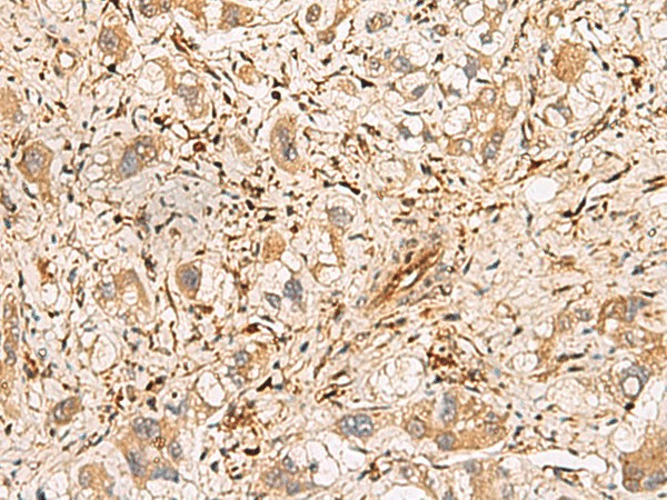 Immunohistochemistry of paraffin-embedded Human liver cancer tissue  using PLCB2 Polyclonal Antibody at dilution of 1:60(?200)