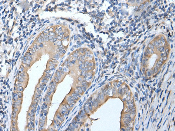 Immunohistochemistry of paraffin-embedded Human cervical cancer tissue  using HSPB1 Polyclonal Antibody at dilution of 1:25(?200)