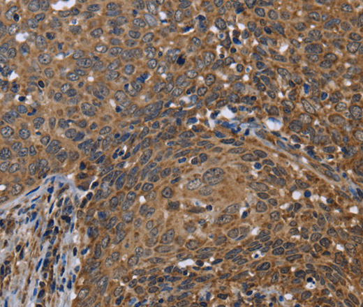 Immunohistochemistry of paraffin-embedded Human cervical cancer tissue using FHIT Polyclonal Antibody at dilution 1:30