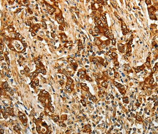 Immunohistochemistry of paraffin-embedded Human gastric cancer using AKR1B1 Polyclonal Antibody at dilution of 1:40