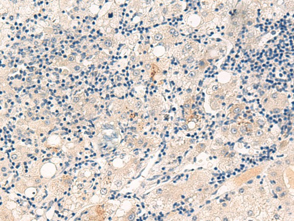 Immunohistochemistry of paraffin-embedded Human liver cancer tissue  using CYYR1 Polyclonal Antibody at dilution of 1:55(?200)