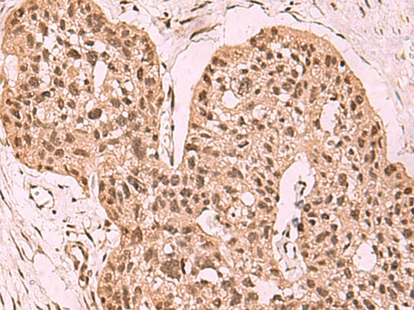 Immunohistochemistry of paraffin-embedded Human esophagus cancer tissue  using SETDB1 Polyclonal Antibody at dilution of 1:60(?200)