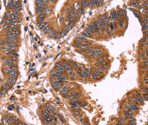 Immunohistochemistry of paraffin-embedded Human colon cancer using ERP29 Polyclonal Antibody at dilution of 1:40