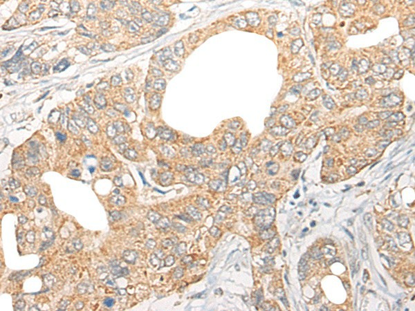 Immunohistochemistry of paraffin-embedded Human gastric cancer tissue  using CCL5 Polyclonal Antibody at dilution of 1:50(?200)