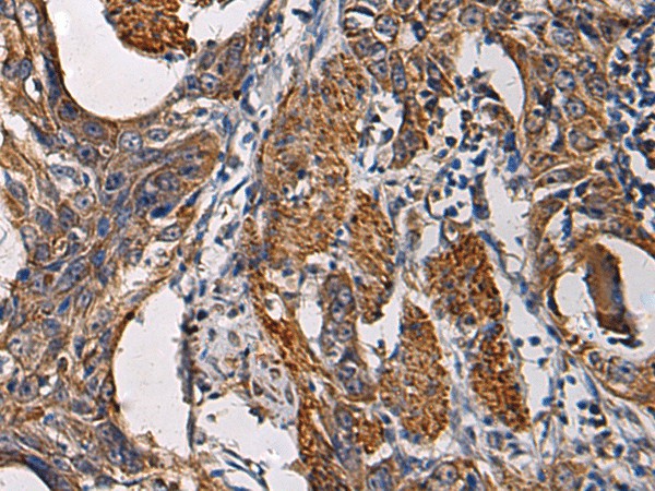 Immunohistochemistry of paraffin-embedded Human esophagus cancer tissue  using SSH3 Polyclonal Antibody at dilution of 1:60(?200)