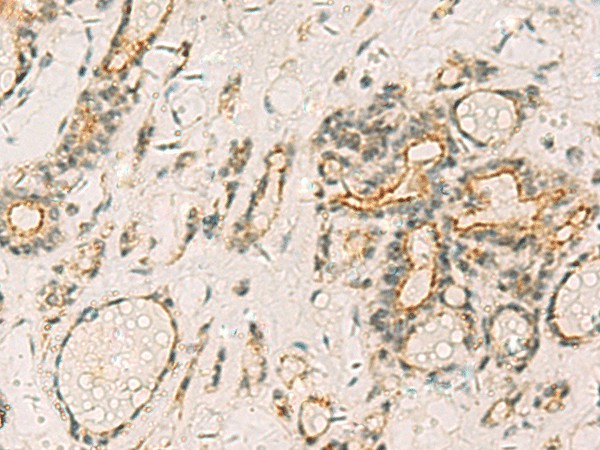 Immunohistochemistry of paraffin-embedded Human thyroid cancer tissue  using HORMAD2 Polyclonal Antibody at dilution of 1:35(?200)