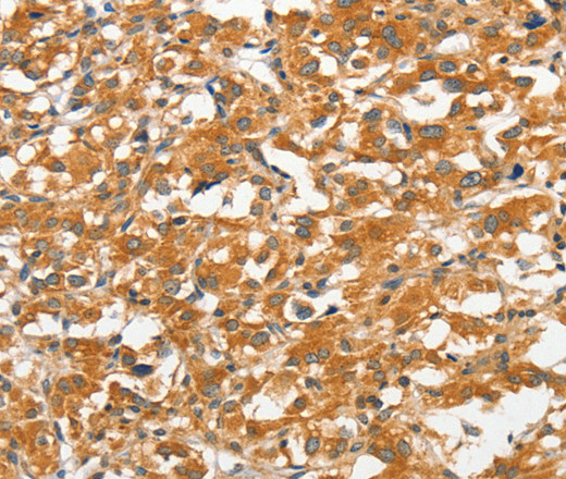 Immunohistochemistry of paraffin-embedded Human thyroid cancer tissue using ANKMY2 Polyclonal Antibody at dilution 1:30