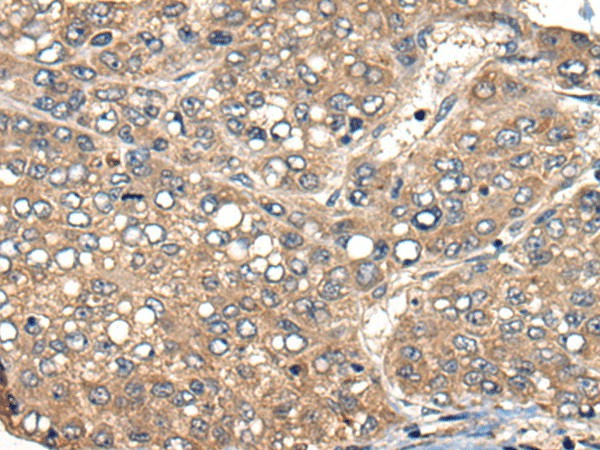 Immunohistochemistry of paraffin-embedded Human liver cancer tissue  using ACER1 Polyclonal Antibody at dilution of 1:50(?200)