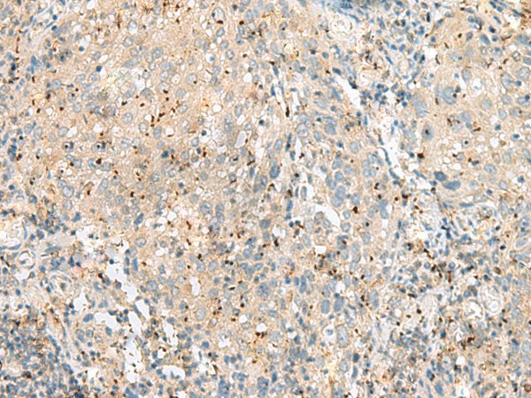 Immunohistochemistry of paraffin-embedded Human cervical cancer tissue  using EIF3L Polyclonal Antibody at dilution of 1:55(?200)