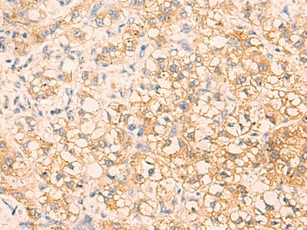 Immunohistochemistry of paraffin-embedded Human liver cancer tissue  using EPCAM Polyclonal Antibody at dilution of 1:40(?200)