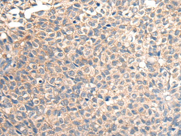 Immunohistochemistry of paraffin-embedded Human ovarian cancer tissue  using TNFRSF10D Polyclonal Antibody at dilution of 1:30(?200)