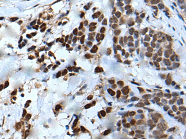 Immunohistochemistry of paraffin-embedded Human thyroid cancer tissue  using VEZT Polyclonal Antibody at dilution of 1:50(?200)