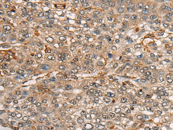 Immunohistochemistry of paraffin-embedded Human liver cancer tissue  using CDT1 Polyclonal Antibody at dilution of 1:45(?200)