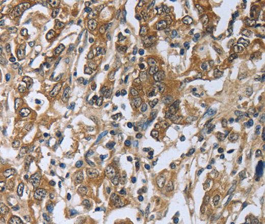 Immunohistochemistry of paraffin-embedded Human gasrtic cancer tissue using PRL Polyclonal Antibody at dilution 1:50