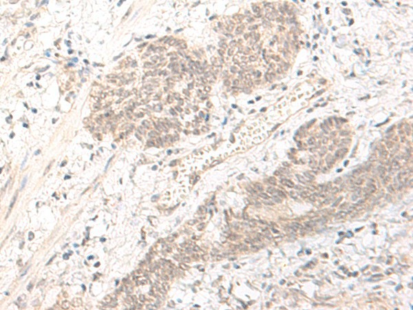 Immunohistochemistry of paraffin-embedded Human esophagus cancer tissue  using PBXIP1 Polyclonal Antibody at dilution of 1:40(?200)