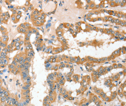 Immunohistochemistry of paraffin-embedded Human thyroid cancer using CD156c Polyclonal Antibody at dilution of 1:30