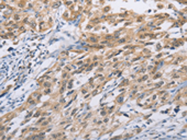 Immunohistochemistry of paraffin-embedded Human esophagus cancer tissue  using ZIC5  Polyclonal Antibody at dilution of 1:100(?200)