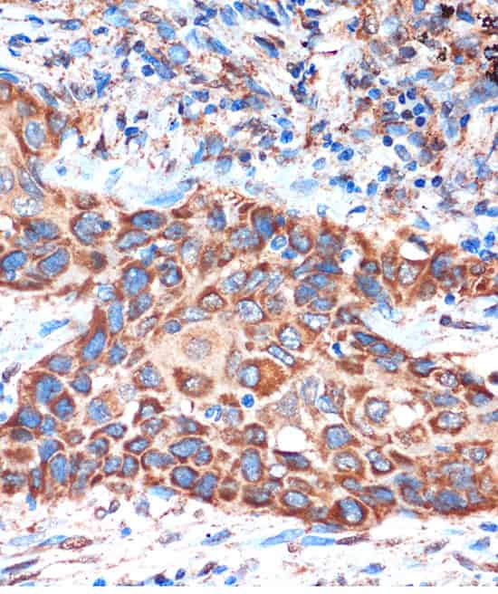 Immunohistochemistry of paraffin-embedded Human lung cancer using HIBADH Polyclonal Antibody at dilution of 1:100 (40x lens).Perform microwave antigen retrieval with 10 mM PBS buffer pH 7.2 before commencing with IHC staining protocol.