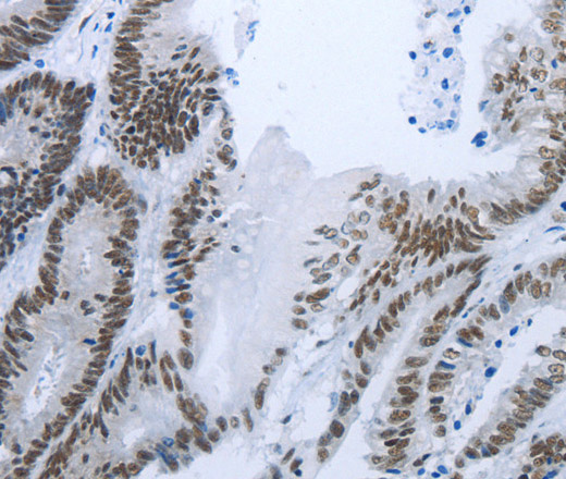 Immunohistochemistry of paraffin-embedded Human colon cancer tissue using RBMS1 Polyclonal Antibody at dilution 1:30