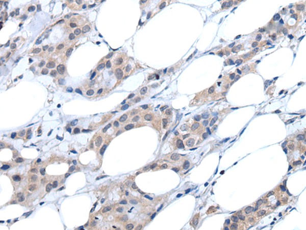 Immunohistochemistry of paraffin-embedded Human breast cancer tissue  using ANGPTL6 Polyclonal Antibody at dilution of 1:55(?200)