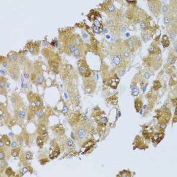 Immunohistochemistry of paraffin-embedded Human liver damage using BNIP3 Polyclonal Antibody at dilution of 1:100 (40x lens).