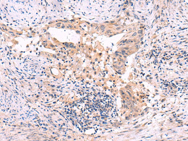 Immunohistochemistry of paraffin-embedded Human cervical cancer tissue  using SLC12A5 Polyclonal Antibody at dilution of 1:40(?200)