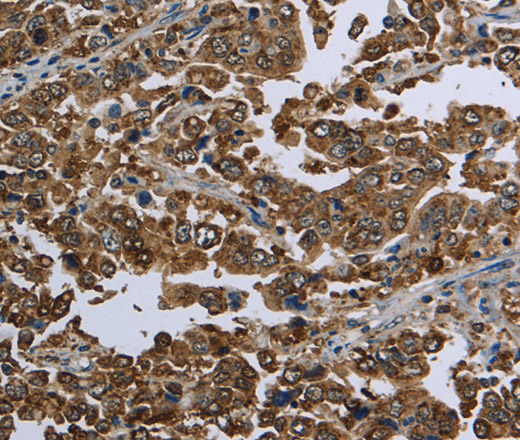 Immunohistochemistry of paraffin-embedded Human liver cancer using HSPA9 Polyclonal Antibody at dilution of 1:50