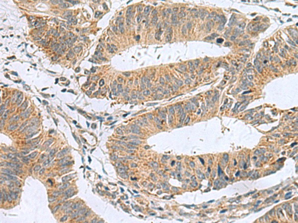 Immunohistochemistry of paraffin-embedded Human colorectal cancer tissue  using MARCKSL1 Polyclonal Antibody at dilution of 1:50(?200)