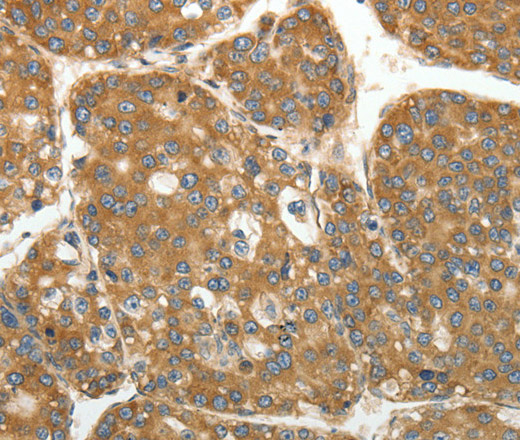 Immunohistochemistry of paraffin-embedded Human liver cancer using RPLP0 Polyclonal Antibody at dilution of 1:40