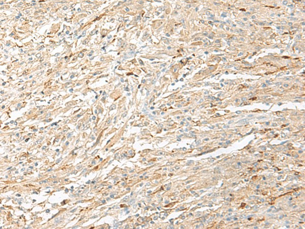 Immunohistochemistry of paraffin-embedded Human liver cancer tissue  using EPRS Polyclonal Antibody at dilution of 1:60(?200)