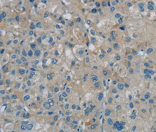 Immunohistochemistry of paraffin-embedded Human liver cancer tissue using PGLYRP1 Polyclonal Antibody at dilution 1:40