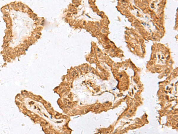 Immunohistochemistry of paraffin-embedded Human thyroid cancer tissue  using FAM84A Polyclonal Antibody at dilution of 1:35(?200)