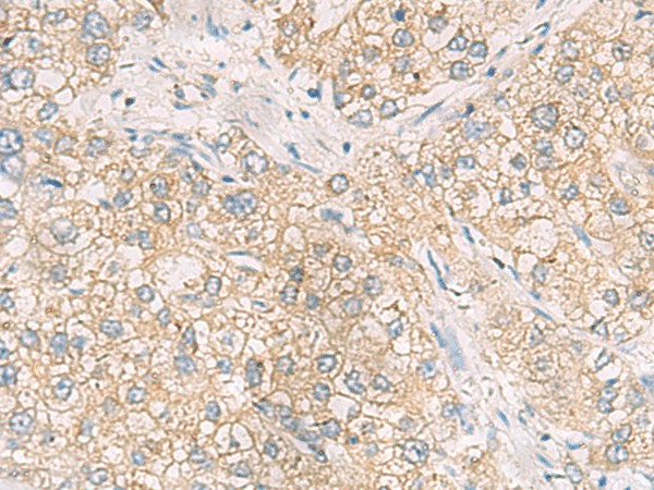 Immunohistochemistry of paraffin-embedded Human liver cancer tissue  using MAPK14 Polyclonal Antibody at dilution of 1:70(?200)