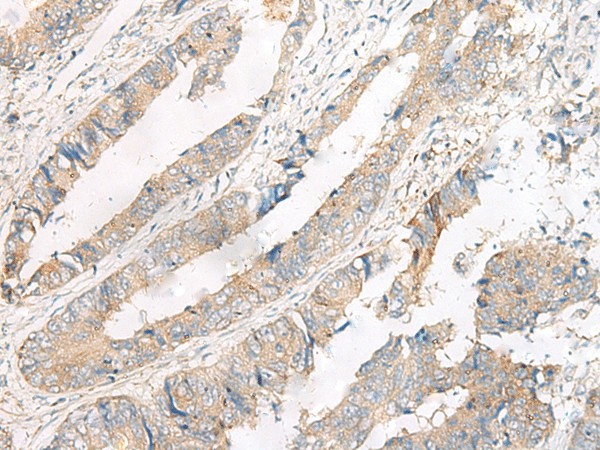 Immunohistochemistry of paraffin-embedded Human colorectal cancer tissue  using FERD3L Polyclonal Antibody at dilution of 1:75(?200)