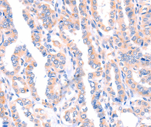 Immunohistochemistry of paraffin-embedded Human thyroid cancer using AMPD1 Polyclonal Antibody at dilution of 1:70