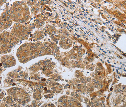 Immunohistochemistry of paraffin-embedded Human liver cancer using CASP12 Polyclonal Antibody at dilution of 1:50