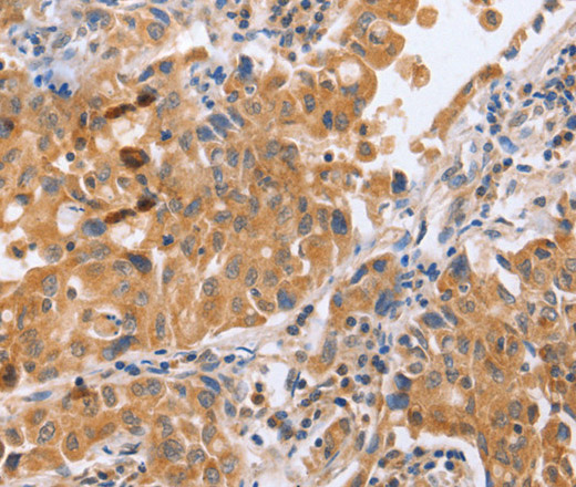 Immunohistochemistry of paraffin-embedded Human lung cancer tissue using BLNK Polyclonal Antibody at dilution 1:50