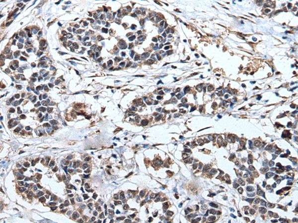 Immunohistochemistry of paraffin-embedded Human esophagus cancer tissue  using PRUNE Polyclonal Antibody at dilution of 1:40(?200)