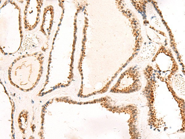 Immunohistochemistry of paraffin-embedded Human thyroid cancer tissue  using DCAF10 Polyclonal Antibody at dilution of 1:130(?200)