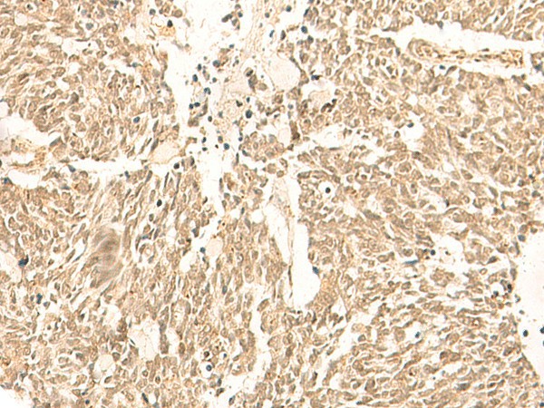 Immunohistochemistry of paraffin-embedded Human lung cancer tissue  using TBPL1 Polyclonal Antibody at dilution of 1:50(?200)