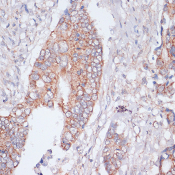 Immunohistochemistry of paraffin-embedded Human colon cancer using MBTPS1 Polyclonal Antibody at dilution of 1:100 (40x lens).