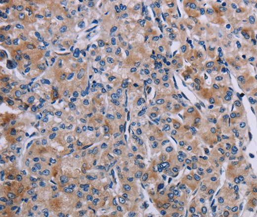 Immunohistochemistry of paraffin-embedded Human prostate cancer tissue using KDM4D Polyclonal Antibody at dilution 1:60