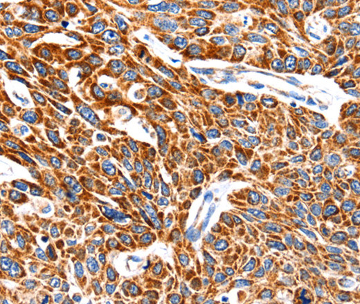 Immunohistochemistry of paraffin-embedded Human esophagus cancer using HSP75 Polyclonal Antibody at dilution of 1:100