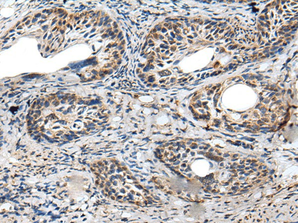 Immunohistochemistry of paraffin-embedded Human cervical cancer tissue  using PRNP Polyclonal Antibody at dilution of 1:45(?200)