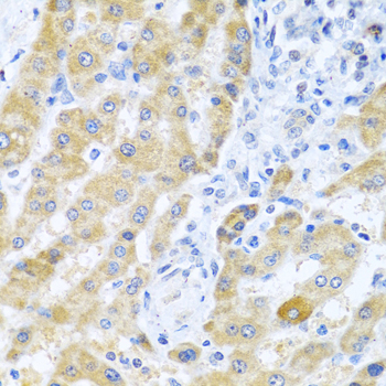 Immunohistochemistry of paraffin-embedded Human liver cancer using Gm13125 Polyclonal Antibody at dilution of  1:100 (40x lens).