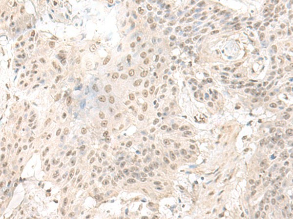 Immunohistochemistry of paraffin-embedded Human esophagus cancer tissue  using ILKAP Polyclonal Antibody at dilution of 1:50(?200)