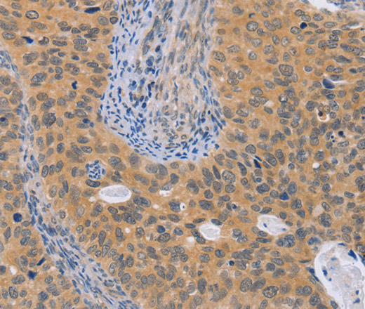 Immunohistochemistry of paraffin-embedded Human cervical cancer using BRS3 Polyclonal Antibody at dilution of 1:50