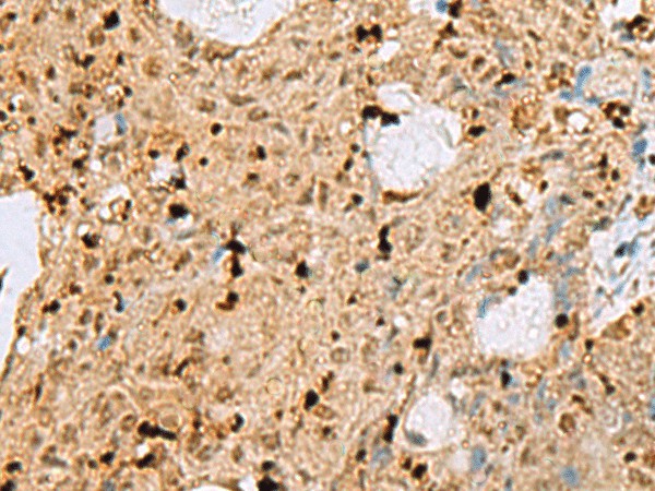 Immunohistochemistry of paraffin-embedded Human ovarian cancer tissue  using MAF Polyclonal Antibody at dilution of 1:25(?200)